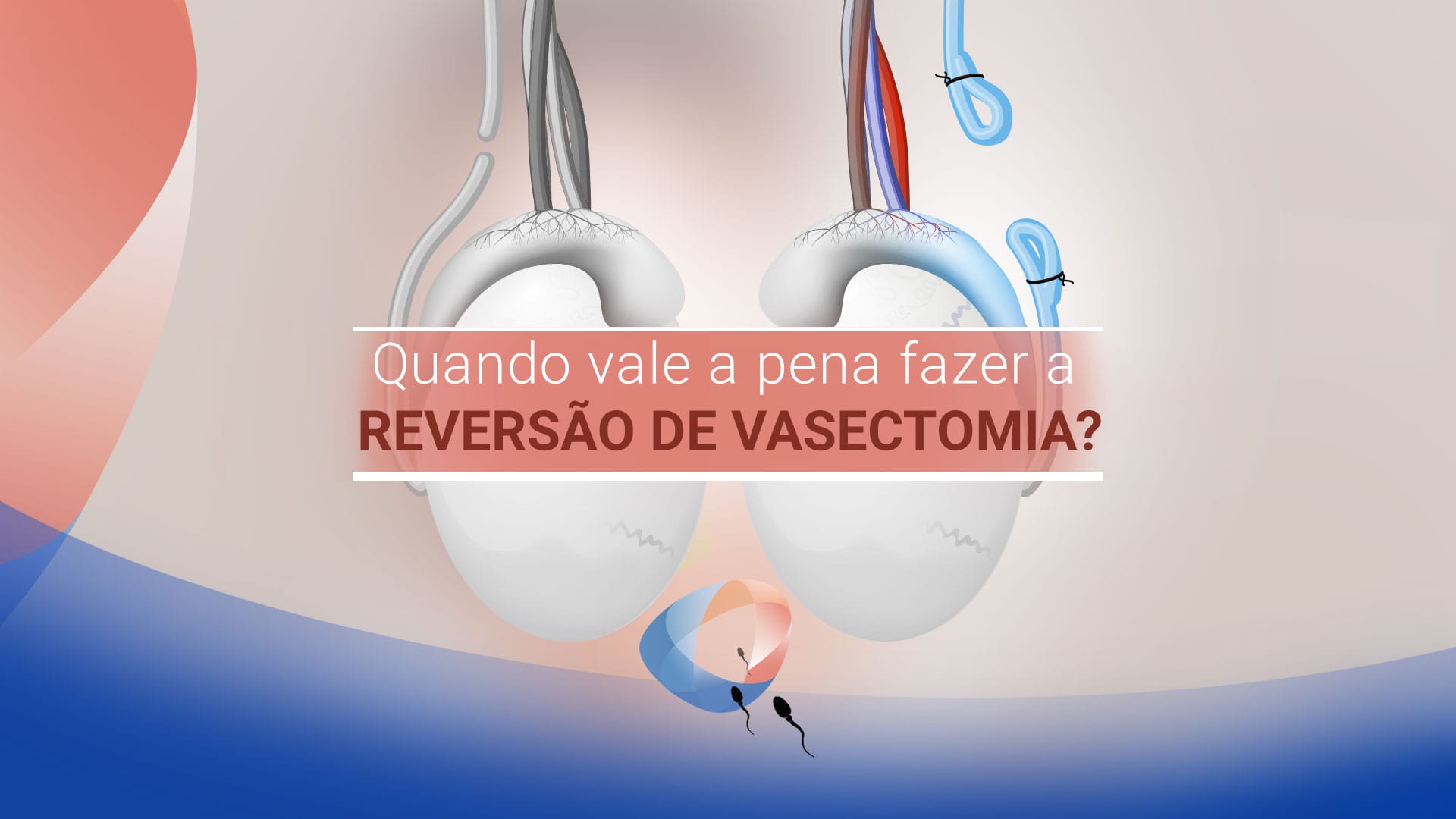 Quando vale a pena fazer a reversão de vasectomia?