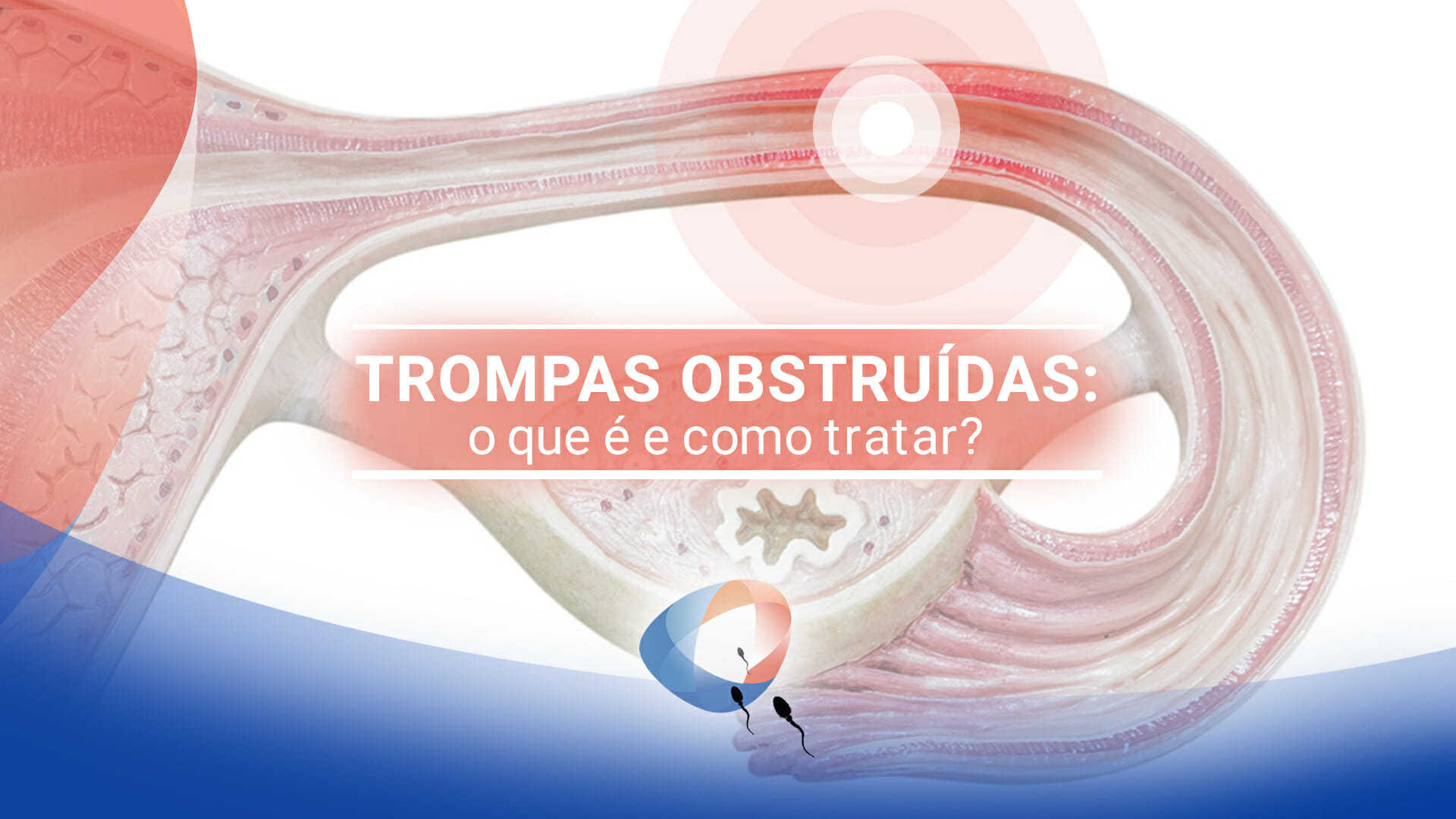 Trompas obstruídas: o que é e como tratar?