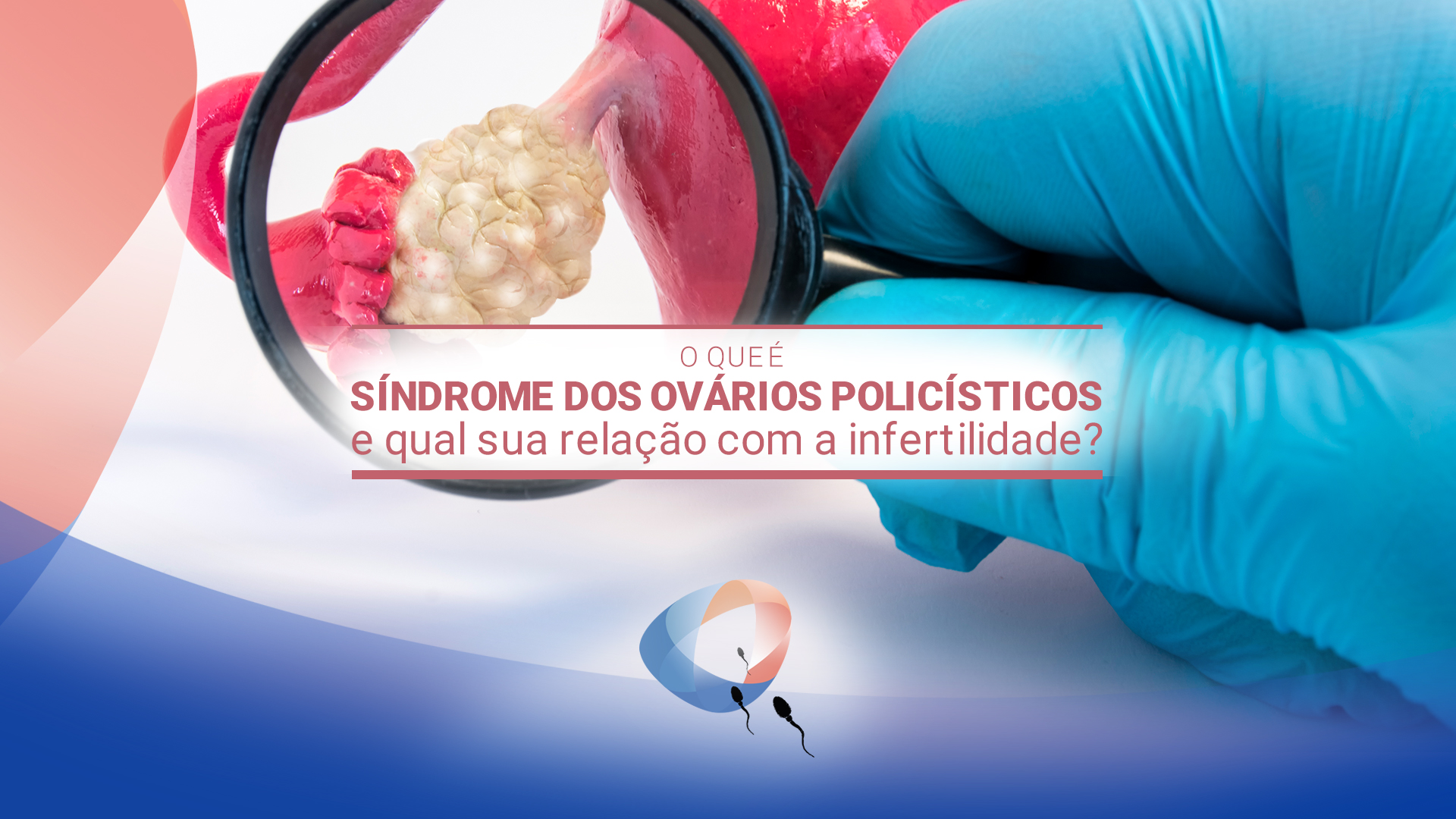 O que é síndrome dos ovários policísticos e qual sua relação com a infertilidade?