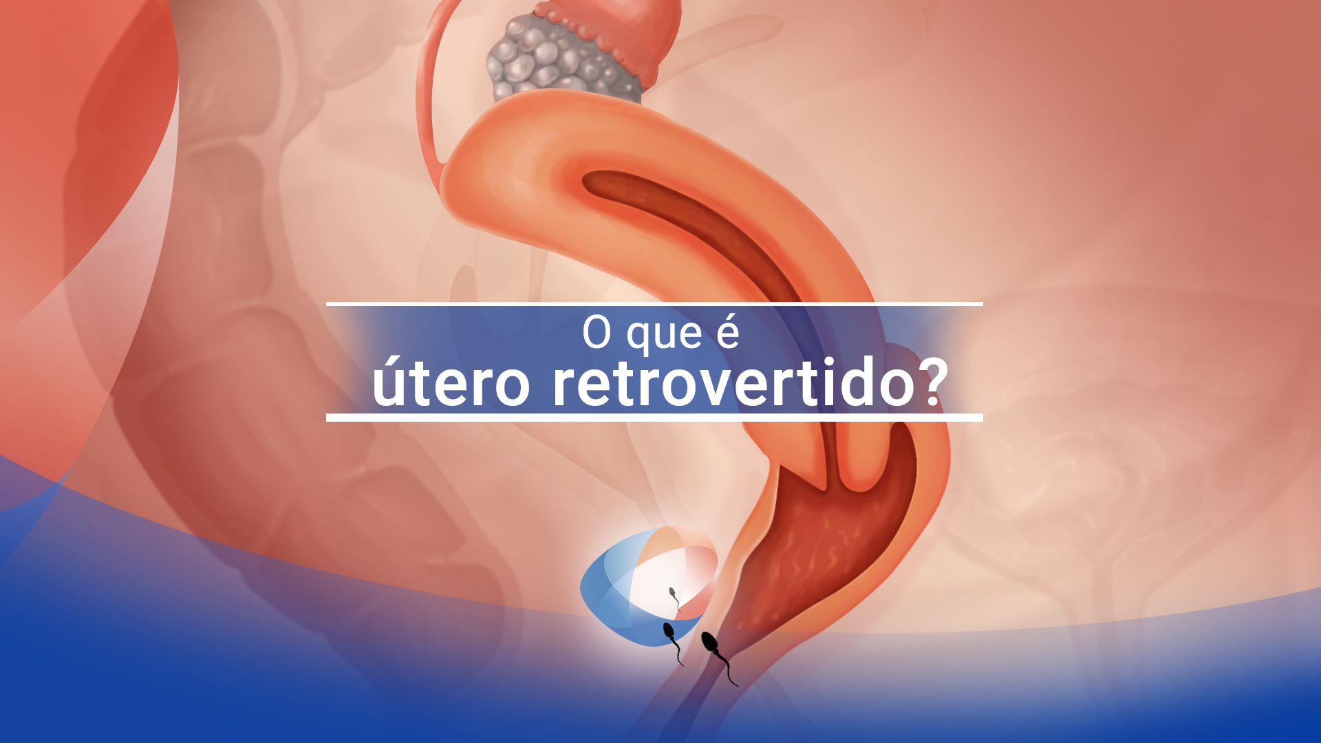 O que é útero retrovertido?