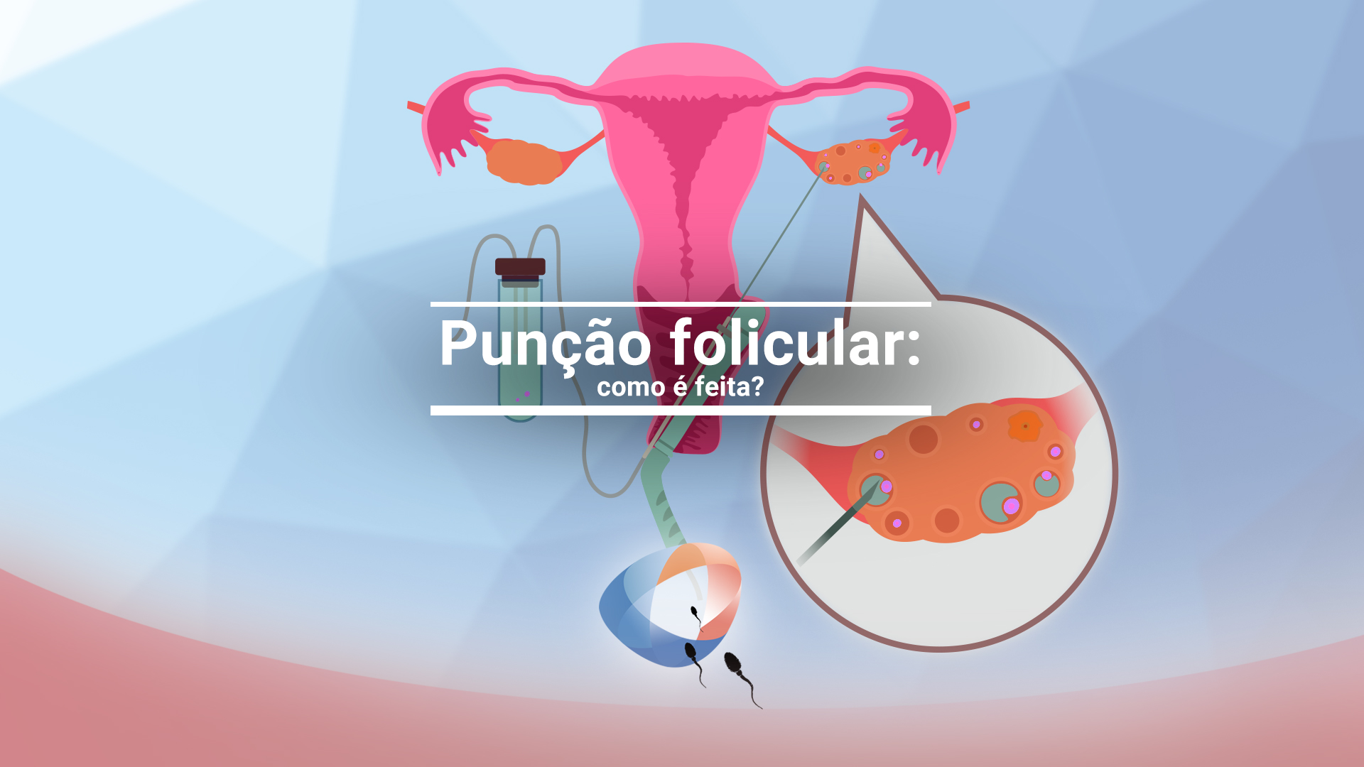 Punção folicular: como é feita?